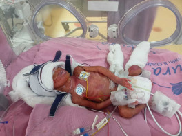 prematureBirthBaby